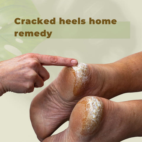 Cracked heels home remedy