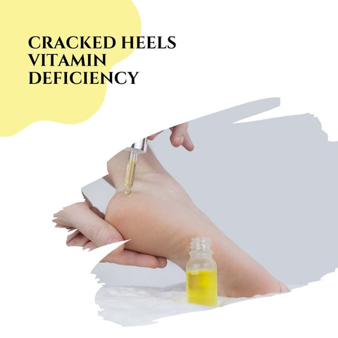 Cracked heels vitamin deficiency