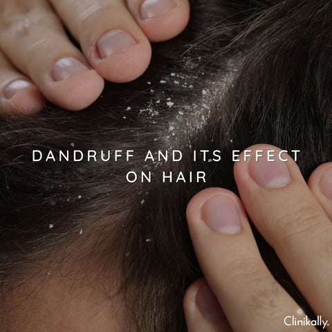 Dandruff and Its Effect on Hair