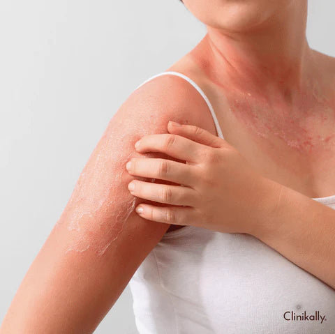 Defining Skin Discolouration From Tanning to Pigmentation