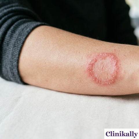 Dermatophyte Infections (Tinea / Ringworm Family)