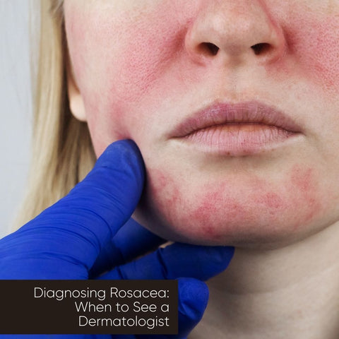 Diagnosing Rosacea: When to See a Dermatologist