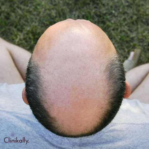 Minoxidil Vs Finasteride