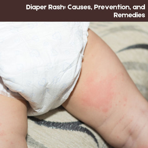 Diaper Rash: Causes, Prevention, and Remedies