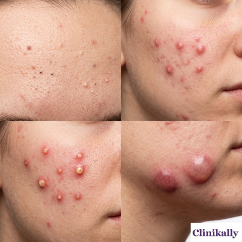 Papules vs pustules acne comparison