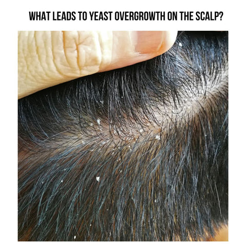 What Leads to Yeast Overgrowth on the Scalp?