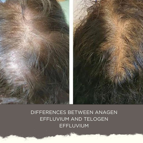 Differences between Anagen Effluvium and Telogen Effluvium