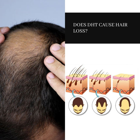 Does DHT Cause Hair Loss?