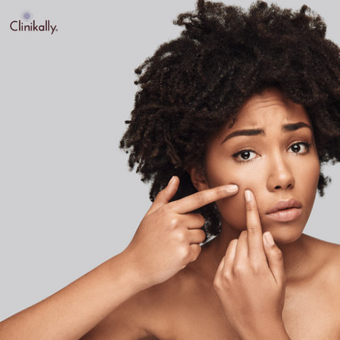 The Truth About Junk Food and Acne: Separating Fact from Fiction