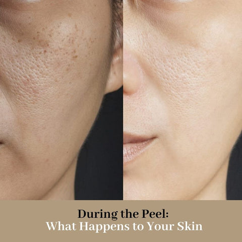 During the Peel: What Happens to Your Skin
