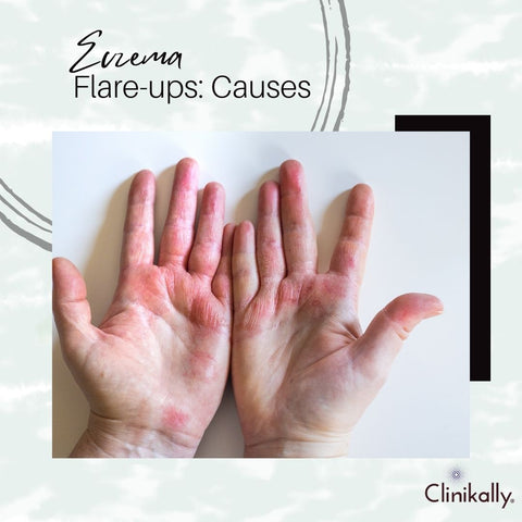 Eczema Flare-ups: Causes