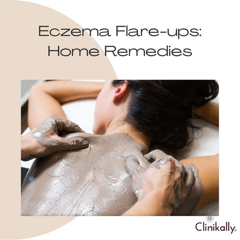 Eczema Flare-ups: Home Remedies