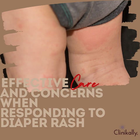 Effective Care and Concerns When Responding to Diaper Rash