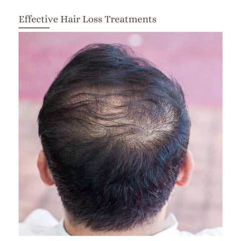 Effective Hair Loss Treatments