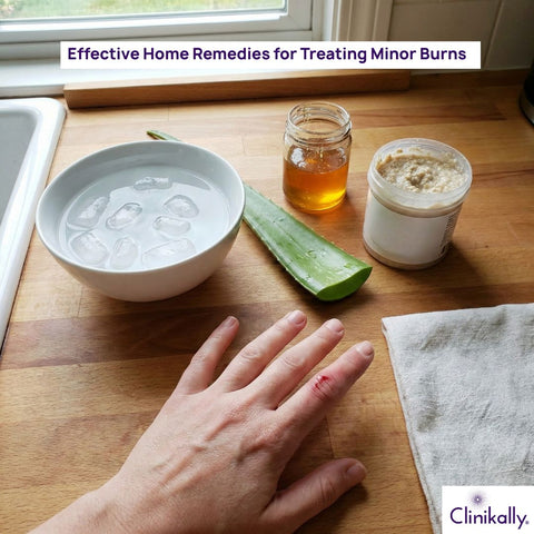 Home Remedies for Treating Minor Burns