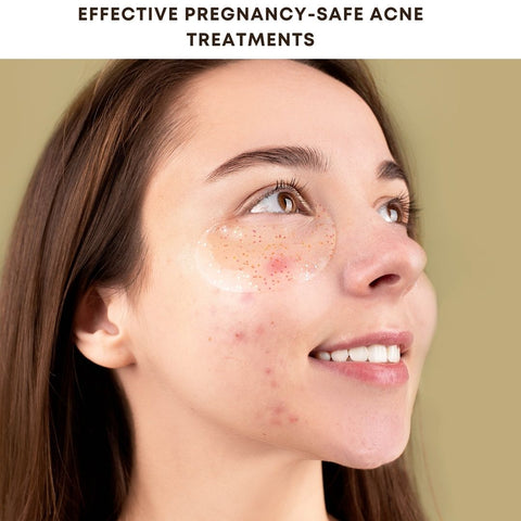 Effective Pregnancy-Safe Acne Treatments