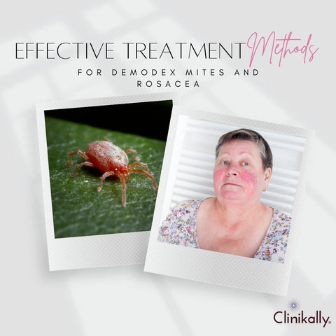 Effective Treatment Methods for Demodex Mites and Rosacea