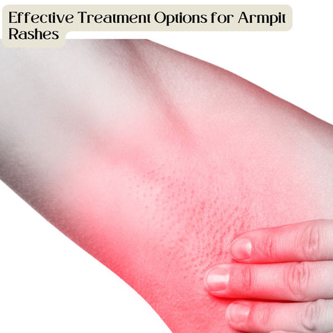 Effective Treatment Options for Armpit Rashes