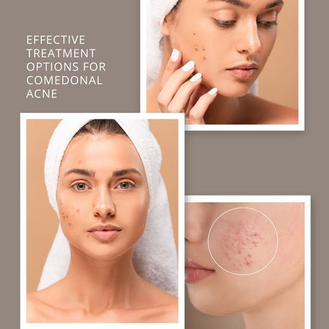 Effective Treatment Options for Comedonal Acne