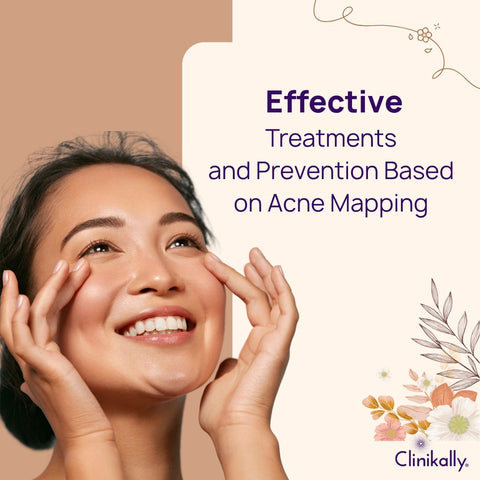 Effective Treatments and Prevention Based on Acne Mapping