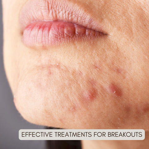 Effective Treatments for Breakouts