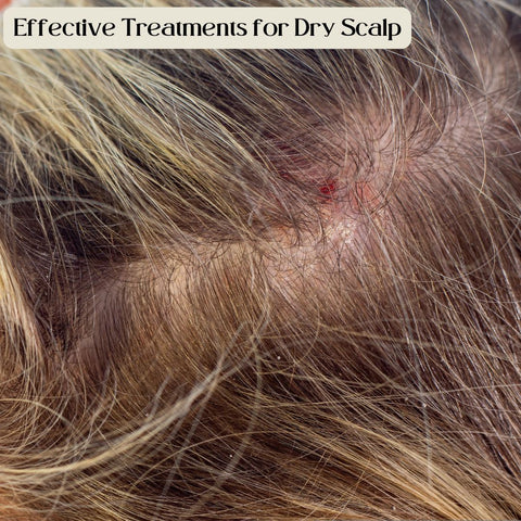 Effective Treatments for Dry Scalp
