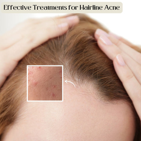 Effective Treatments for Hairline Acne