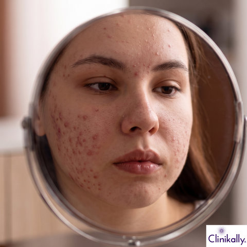 Woman with hormonal acne caused by PMOS