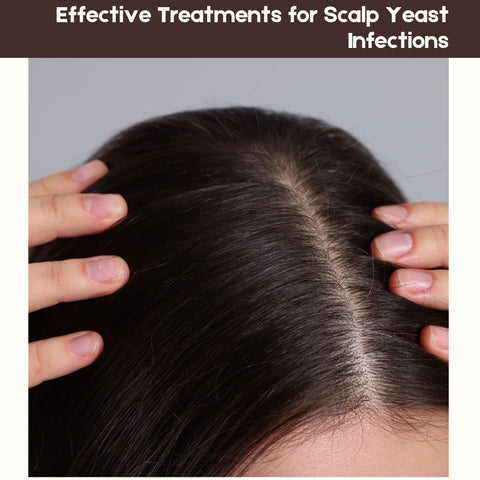 Effective Treatments for Scalp Yeast Infections