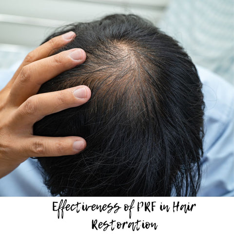 Effectiveness of PRF in Hair Restoration
