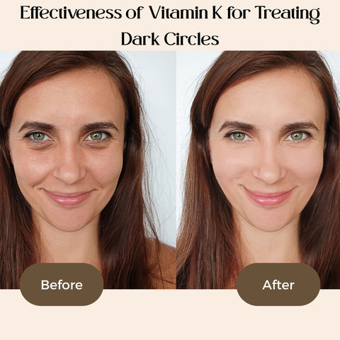 Effectiveness of Vitamin K for Treating Dark Circles