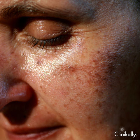 Effects of UV radiation on skin pigmentation