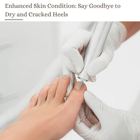 Enhanced Skin Condition: Say Goodbye to Dry and Cracked Heels