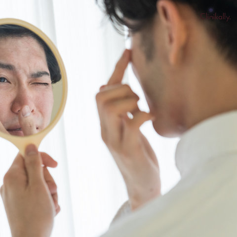 Acne Purge vs Breakout