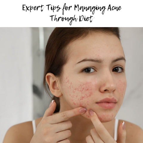 Expert Tips for Managing Acne Through Diet
