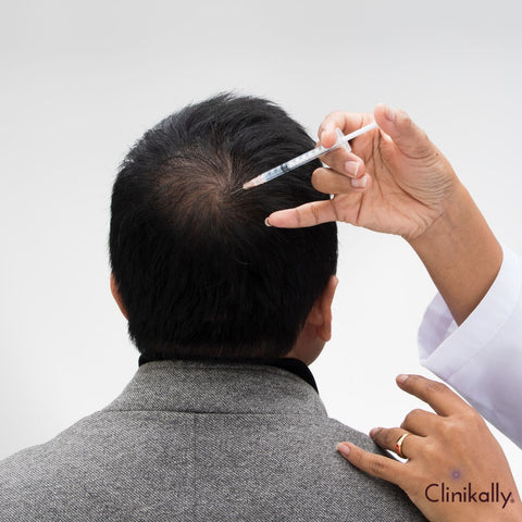 Exploring the scientific research supporting the efficacy of topical finasteride