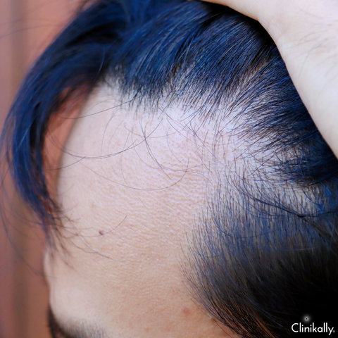 Detail of hair thinning at the temple and hairline.