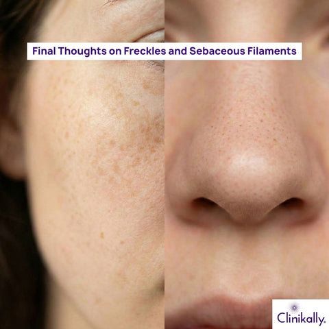 Final Thoughts on Freckles and Sebaceous Filaments