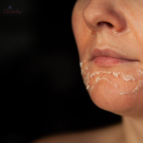 Flaky Skin: Causes and Types