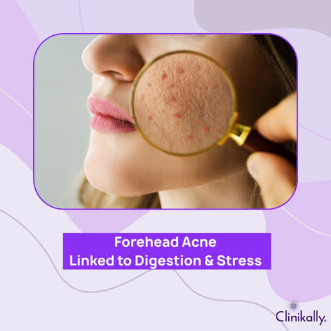 Forehead Acne: Linked to Digestion & Stress