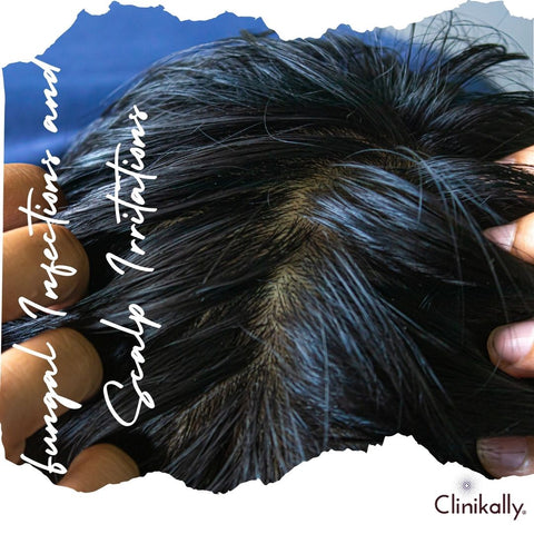 Fungal Infections and Scalp Irritations