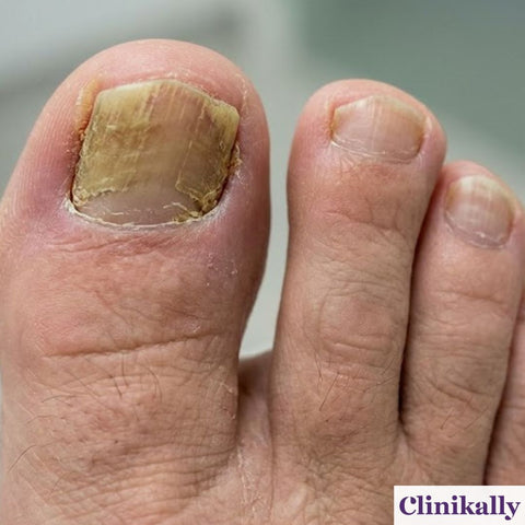 Fungal Nail Infections (Onychomycosis)