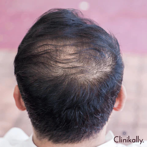Is Redensyl better than Minoxidil?