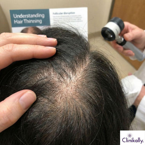 Scalp with hair thinning