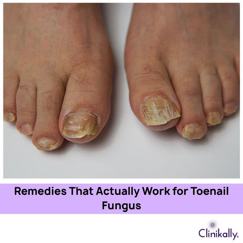 Remedies That Actually Work for Toenail Fungus