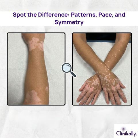 Difference between segmental and non-segmental vitiligo