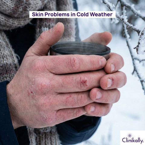 Common Winter Skin Problems