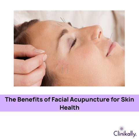 The Benefits of Facial Acupuncture for Skin Health