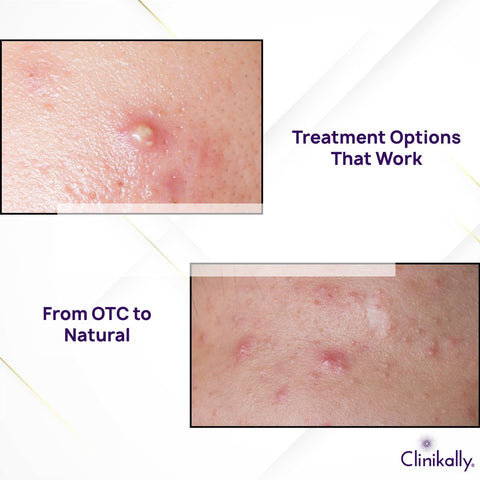 Treatment Options That Work: From OTC to Natural