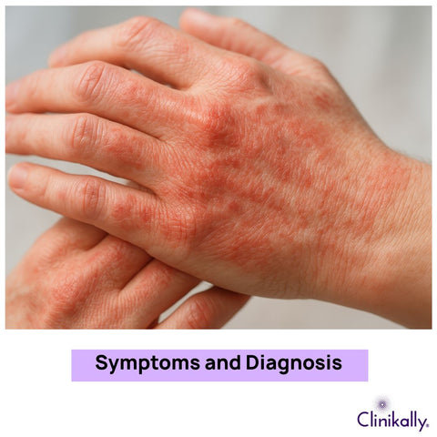 Pityriasis Rosea Symptoms and Diagnosis